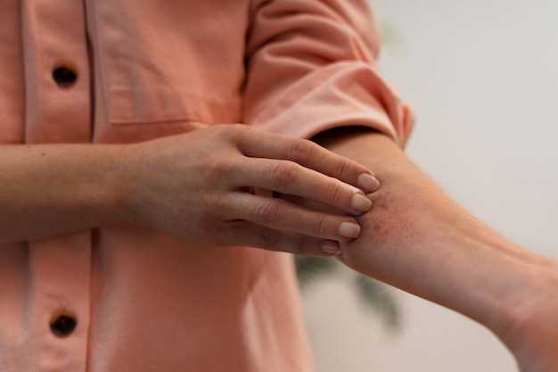Atorvastatin urticaria